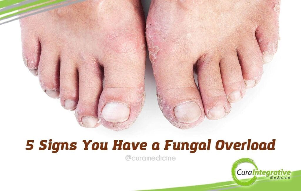 5-Signs-Fungal-Overload signs of fungal overload